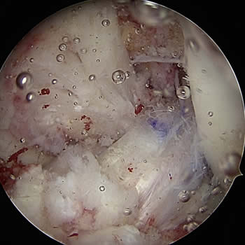 Artroscopia de rodilla para reconstrucción de ligamento cruzado anterior