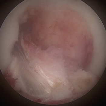 Artroscopia de rodilla para reconstrucción de ligamento cruzado anterior