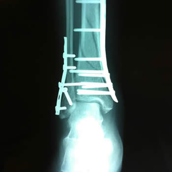 Reconstrucción de fractura de tobillo con placa y tornillos