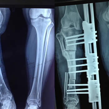 Reconstruccion con elongacion ósea de fractura antigua de tibia con deformidad, infección y pérdida ósea