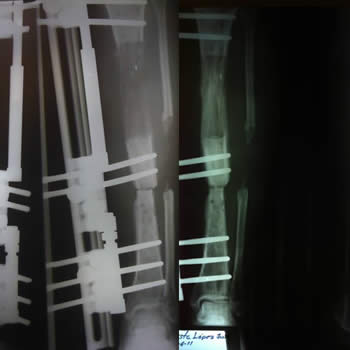Reconstruccion con elongacion ósea de fracturade tibia con pérdida ósea