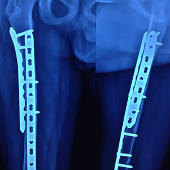 Reconstruccion de fémur con injerto en tumor pediátrico