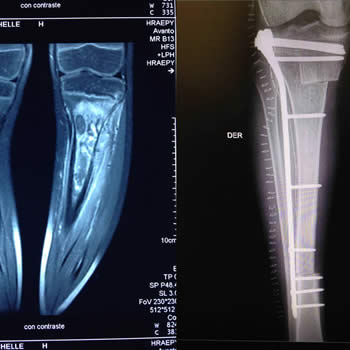 Tumor maligno  de tibia reconstruccion con injerto