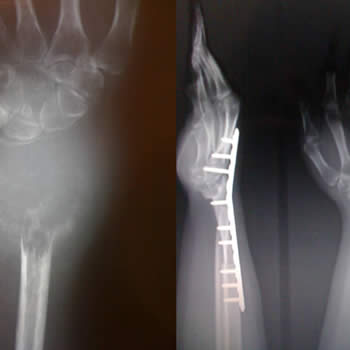 Reconstrucción de muñeca por tumor maligno con injerto