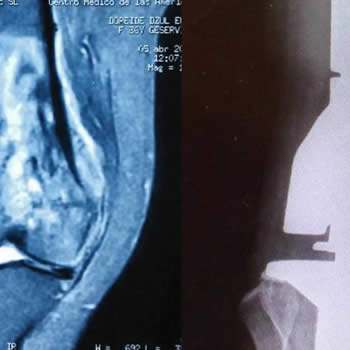 Prótesis por tumor de fémur maligno