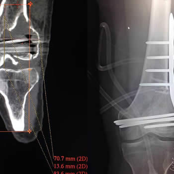Reconstrucción con injerto y placa de tumor de células gigantes en fémur