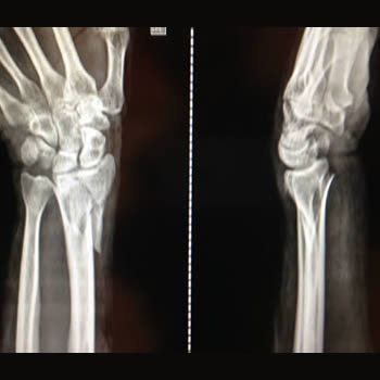 Fractura de radio distal