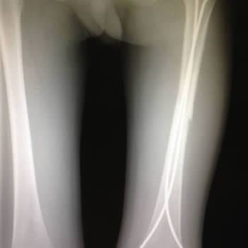 Fractura de fémur pediátrico