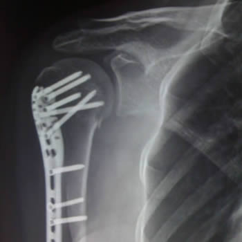 Fractura de húmero proximal