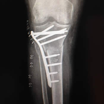 Fractura de tibia proximal